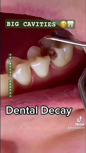 BIG CAVITIES 🦷🥴