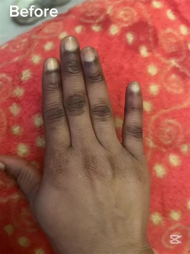 Tca solution peel on TikTok