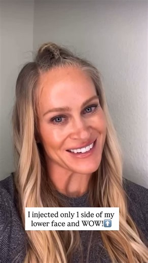 Melissa | Orlando Injector | Botox & Facial Balancing on Instagram: "I treated only one side of the lower face so you can clearly see the difference. ❓What DAO + chin tox do for you: • Less downward pull at the mouth corners • A smoother, less dimpled chin • A softer, more relaxed resting expression • Better balance in the lower face — without filler 💡This treatment relaxes overactive muscles so your face looks refreshed, not frozen. ✨Subtle changes. Natural results. #botox #dao #chintox #lower