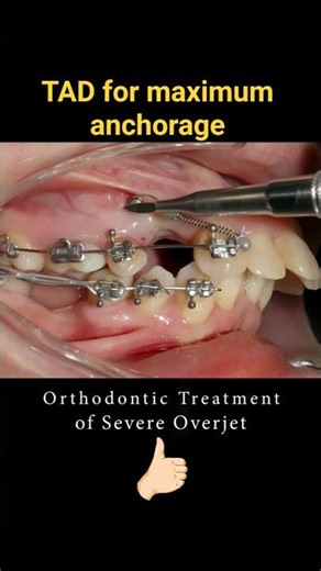 Buck Teeth often need extractions of premolars! #shorts #dentist #orthodontist