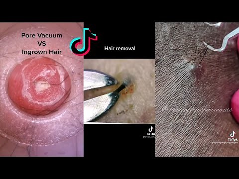INGROWN HAIR REMOVAL COMPILATION