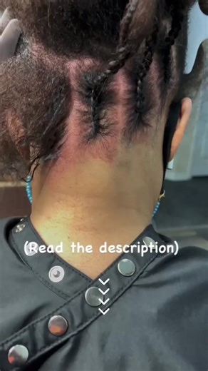 Why is her scalp so red? 😱 Dermatographia 😳 •It’s a skin condition •The signs occur within a few minutes of your skin being rubbed or scratched. •It clears up in 30 minutes. Her scalp turned red just from me parting it. So every time you see someone scalp red doesn’t mean the stylist is being rough. 🤷🏽‍♀️ Don’t assume that every stylist is braiding tight cause that’s not always the case. #hair #info #dermatographia #redskin