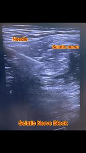 129K views · 506 reactions | Sciatic Nerve Block #for managment of Sciatica | Cardiophilia | Facebook