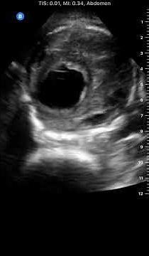 AAA: Butterfly iQ Clinical Images