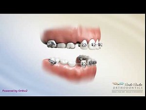 Phase I Braces - 2x4 Appliance