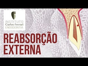 External root resorption