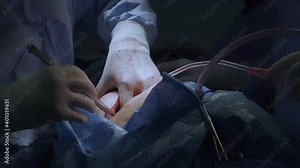 Thoracic surgeons performing a left lower lobe lung surgery. Medical themes