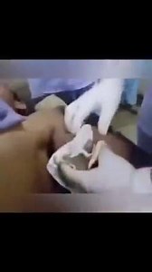 5.4K views · 41 reactions | Biceps abscess drainage Synthol is not...