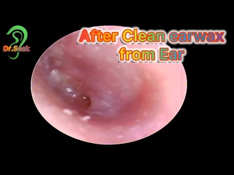 most massive impacted earwax removal by (Dr.Seak)