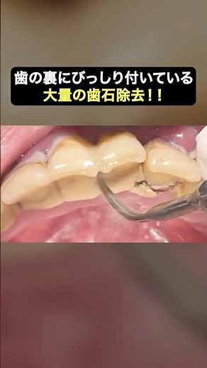歯の裏にびっしり付いた歯石を除去‼️#ザホワイトデンタルクリニック #歯医者 #歯石除去