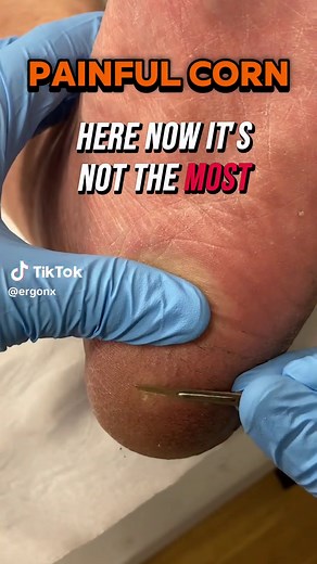 Effective Seed Corn Removal for Heel Pain Relief