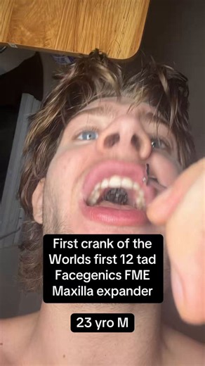 We’ve come full circle where prescribed orthodontic appliances like palate expanders are being confused with looksmaxxing DIY anticsThis is a completely normal procedure that’s been done for decades, and I’m sorry you had to find out this way.