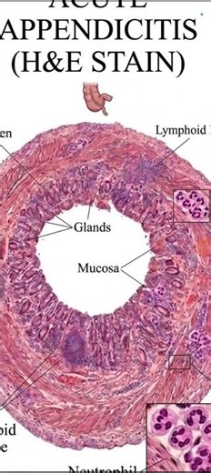 Acute Appendicitis Histopathology #biology