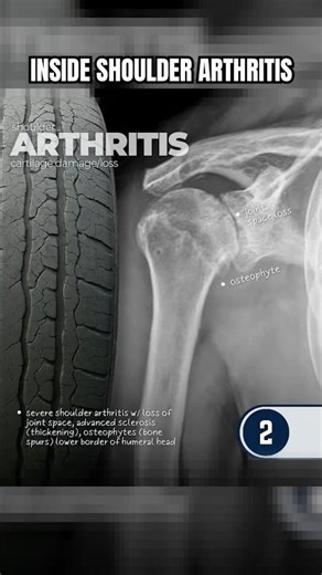 Inside Look At Devastating Shoulder Arthritis Damage⁉️