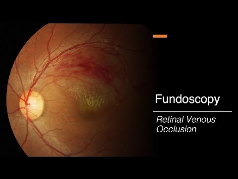 Retinal Venous Occlusion: Fundoscopy