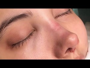 smooth nasal bridge ౨ৎ nose hump removal