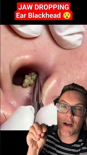 Jaw Dropping EAR BLACKHEAD REMOVAL - Unbelievably Satisfying #shorts