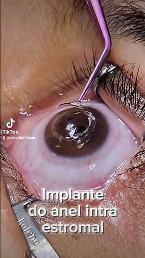 Implante de anel intra estromal para amenizar irregularidades da córnea no tratamento do Ceratocone