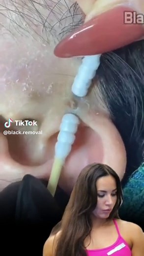 Big Monster Blackheads Extraction | Satisfying Skincare | Blackhead Removal