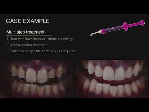 Icon Resin Infiltration By Dr Ankeet Shah- 42nd ASCE