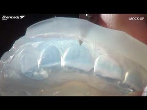 Veneers Procedure Overview Mockup step1