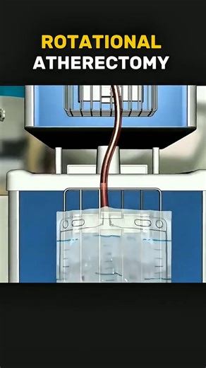 181K views · 1.5K reactions | Rotational Atherectomy (3d Animations). Disclaimer: This video is for educational purposes only and is intended to raise awareness about medical procedures. It does not violate TikTok community guidelines and contains no graphic or harmful content. #rotationalatherectomy #medicaleducation #healthawareness #healtheducation #medicalanimation | Surgery Page | Facebook