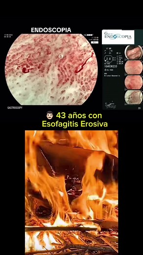 Esofagitis Erosiva: Síntomas, Complicaciones y Prevención