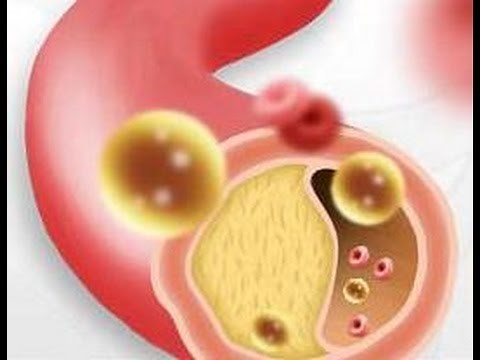 ATEROMATOSIS AORTICA CALCIFICADA
