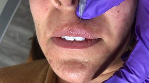 Thanks to Revanesse Versa we we're able to achieve a really beautiful and natural look! Using the AAFE Right Angle Technique, we gave her some amazing lip show and height. With safe injection techniques and knowing your anatomy, creating stunning pouts is totally possible and easy! Especially when you are properly trained. Click the link in our bio to find training opportunities near you! Now is the time to create your dream practice! Invest in your career, increase your skills, and learn the be
