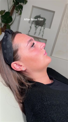 Nose Filler Journey: Before, During, and After Treatment