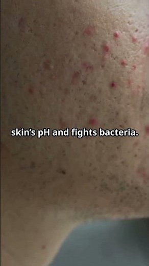 Top 5 Natural Remedies for Acne!