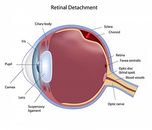 Retinal Detachment Encino | Treatment Advances for Retinal Detachment