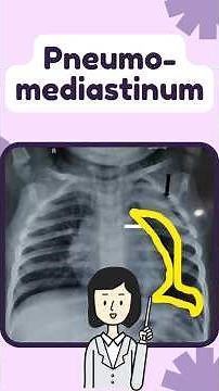 Pneumomediastinum #anatomy #emergencymedicine #emergencyresponse