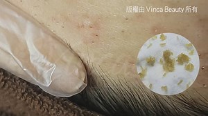 253K views · 241 reactions | 지금 당장 피지를 제거해야하는 이유 피르가즘 개쩐다.. 묵혀둔 피지박살 각 (1+1+1 댓글에 좌표 있어요♥) @헐 이걸로 피지박살 ㄱㄱㄱ | 명언 | Facebook