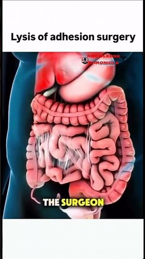 Lysis of Adhesions Surgery: How Surgeons Remove Painful Adhesions in the Operating Room #shorts