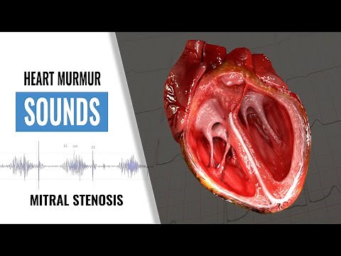 Mitral Stenosis Heart Sound | Heart Sounds | Heart Murmur | Christina NP