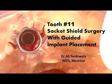 Socket Shield Surgery with Guided Implant Placement