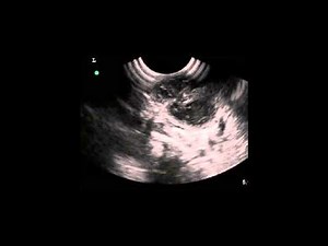 Peritonsillar abscess, drained w direct US guidance