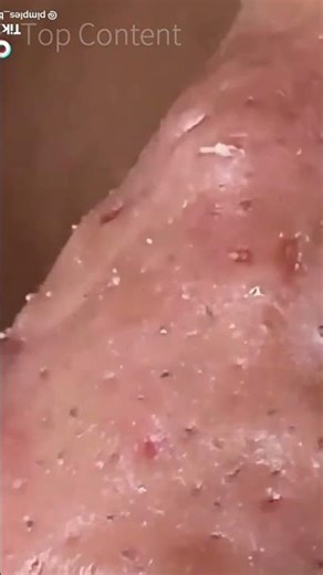 blackhead removal on nose huge cluster part 2