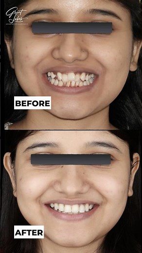Before and After | Dental Braces | Clear Aligner - #dentistry #dentist #braces #invisalign #spark