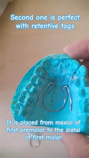 Coffin spring wire bending in orthodontics | 19 guage | Deep palate Dental stone cast