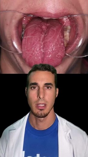 LENGUA GEOGRÁFICA o GLOSITIS MIGRATORIA - Causa y tratamiento #shorts