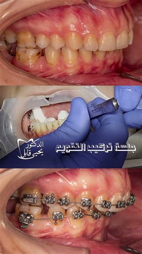 Getting Braces: What Happens in the First Visit