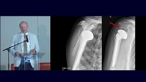 Geriatrics: Complex Proximal Humerus Fractures