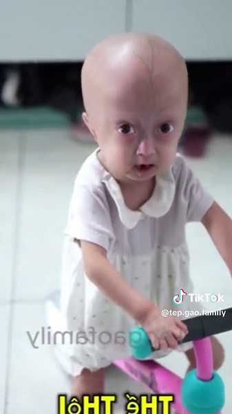 Entendendo a Síndrome de Progeria e O Seu Impacto