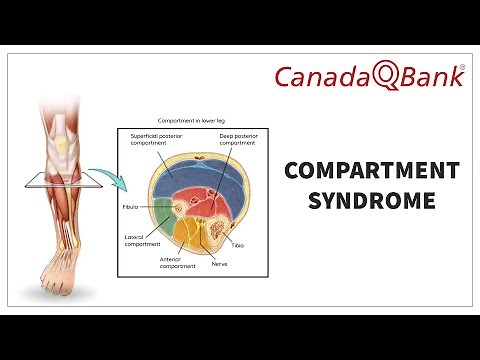 Compartment Syndrome: 6 Ps, Diagnosis & Management | Orthopedic Emergency Explained | CanadaQBank