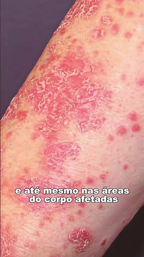 Qual Remédio Tomar Para Psoríase? Entenda as Opções #psoriase #saudedapele #tratamento