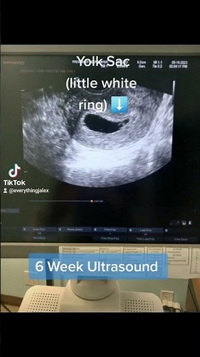 6 week Ultrasound