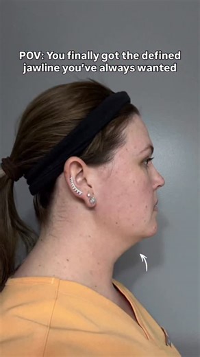 Quatela Center for Plastic Surgery Rochester NY on Instagram: "Incredible 3-month progress with deep neck contouring! This advanced surgical technique pioneered by Dr. Quatela goes beyond surface treatments to: ✨ Tighten the platysma muscle layer for lasting definition ✨ Remove deep fat compartments that diet and exercise can’t touch ✨ Sculpt a permanent, natural-looking jawline and neck contour By 3 months post-op: - Continued refinement as residual swelling subsides - Increasingly visible neck