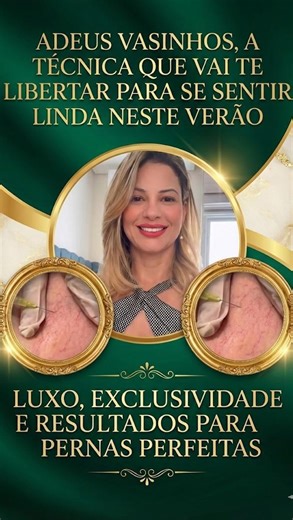 Anna Teodoro on Instagram: "Verão tá chegando e os vasinhos já estão te travando? 😮‍💨 Short, saia, biquíni… e você só pensa em esconder as pernas? Com o protocolo de secagem de vasinhos (PEiM) é possível tratar os microvasos e voltar a se sentir livre, leve e confiante. ✨ 🚨 Atenção: quanto antes iniciar, melhor para chegar na estação com o resultado evoluindo. 📩 Me chama no direct com “VASINHOS” e eu te explico a avaliação + o plano ideal. #autoestima #transformação #peleperfeita #coisasdean